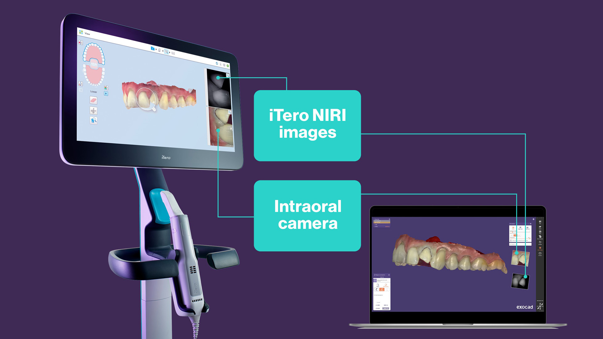 The iTero NIRI (near-infrared imaging) technology.